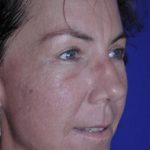 Face and Neck Rejuvenation Case 6541, After Treatment, Female Patient, Thumbnail 1