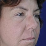 Face and Neck Rejuvenation Case 6541, Before Treatment, Female Patient, Thumbnail 1