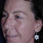 Face and Neck Rejuvenation Case 6541, After Treatment, Female Patient, Thumbnail 2
