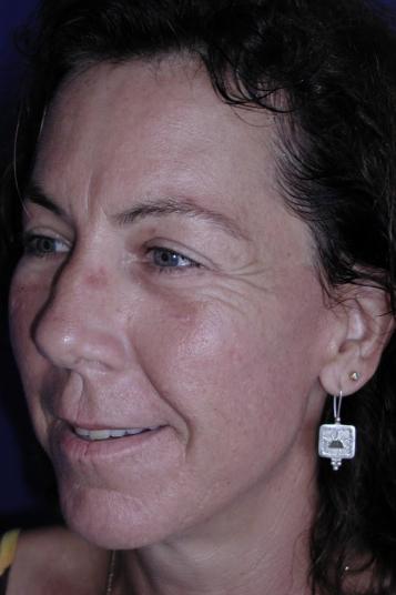 Face and Neck Rejuvenation Case 6541, After Treatment, Female Patient, Set 2