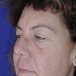Face and Neck Rejuvenation Case 6541, Before Treatment, Female Patient, Thumbnail 2