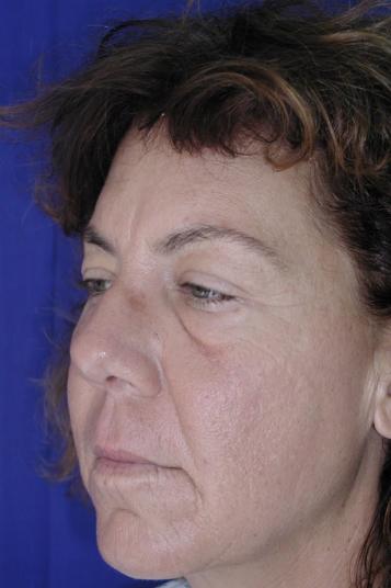 Face and Neck Rejuvenation Case 6541, Before Treatment, Female Patient, Set 2