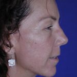 Face and Neck Rejuvenation Case 6541, After Treatment, Female Patient, Thumbnail 3