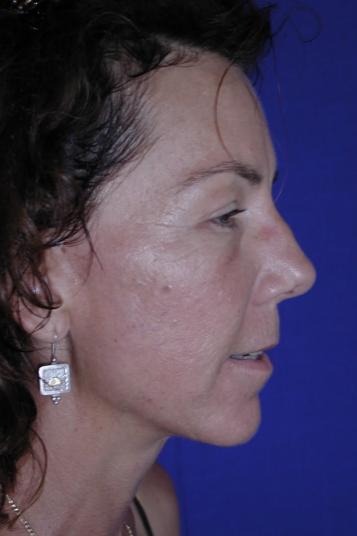 Face and Neck Rejuvenation Case 6541, After Treatment, Female Patient, Set 3