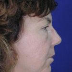 Face and Neck Rejuvenation Case 6541, Before Treatment, Female Patient, Thumbnail 3