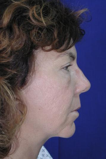 Face and Neck Rejuvenation Case 6541, Before Treatment, Female Patient, Set 3