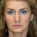 Face and Neck Rejuvenation Case 6481, Before Treatment, Female Patient, Thumbnail 1