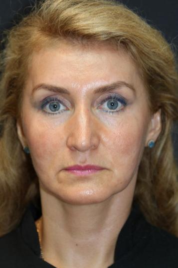Face and Neck Rejuvenation Before Photo