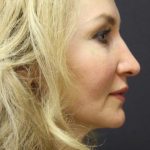 Face and Neck Rejuvenation Case 6481, After Treatment, Female Patient, Thumbnail 2