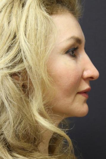Face and Neck Rejuvenation Case 6481, After Treatment, Female Patient, Set 2