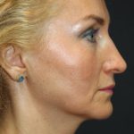 Face and Neck Rejuvenation Case 6481, Before Treatment, Female Patient, Thumbnail 2