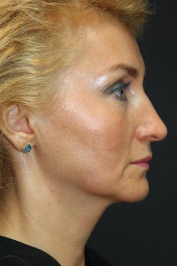Face and Neck Rejuvenation Case 6481, Before Treatment, Female Patient, Set 2