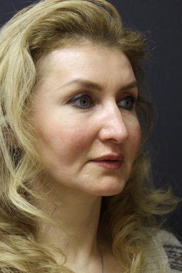 Face and Neck Rejuvenation Case 6481, After Treatment, Female Patient, Set 3