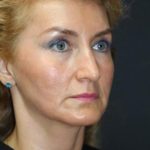 Face and Neck Rejuvenation Case 6481, Before Treatment, Female Patient, Thumbnail 3
