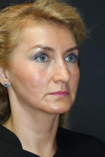 Face and Neck Rejuvenation Case 6481, Before Treatment, Female Patient, Set 3