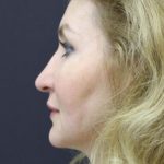 Face and Neck Rejuvenation Case 6481, After Treatment, Female Patient, Thumbnail 4