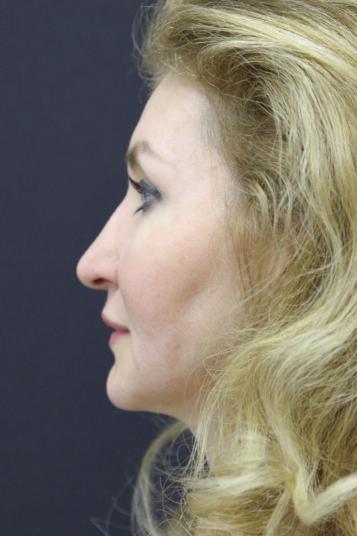 Face and Neck Rejuvenation Case 6481, After Treatment, Female Patient, Set 4