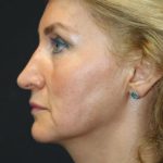 Face and Neck Rejuvenation Case 6481, Before Treatment, Female Patient, Thumbnail 4