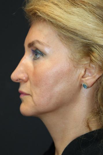 Face and Neck Rejuvenation Case 6481, Before Treatment, Female Patient, Set 4