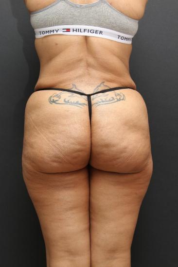 Jersey Shore Butt Lift Case 6747, After Treatment, Female Patient, Set 6