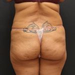 Jersey Shore Butt Lift Case 6747, Before Treatment, Female Patient, Thumbnail 6