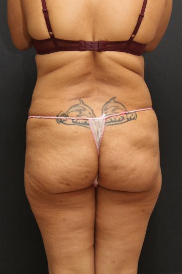 Jersey Shore Butt Lift Case 6747, Before Treatment, Female Patient, Set 6