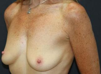 Breast Augmentation Case 6759, Before Treatment, Female Patient, Set 2