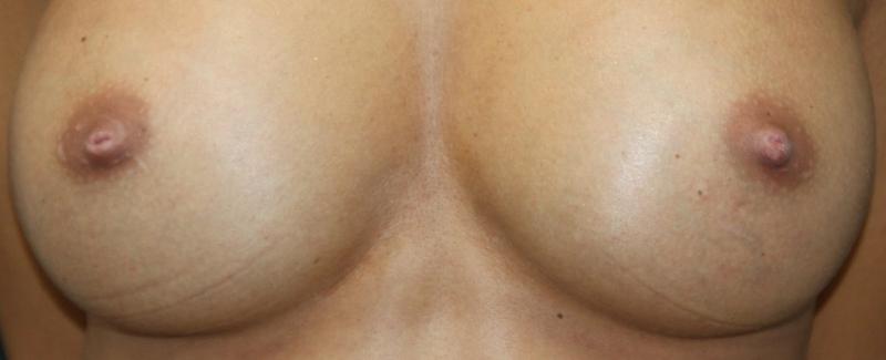 Nipple Correction After