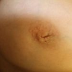 Nipple Correction Case 6797, Before Treatment, Female Patient, Thumbnail 2