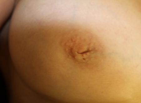 Nipple Correction Case 6797, Before Treatment, Female Patient, Set 2