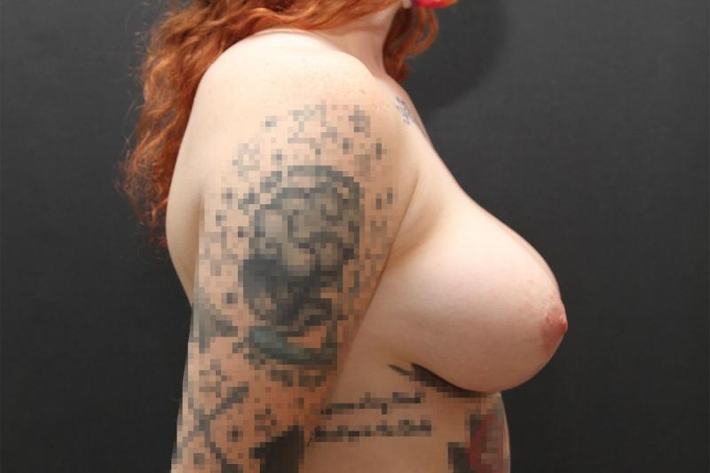 Breast Lift Case 6802, After Treatment, Female Patient, Set 5