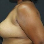 Breast Lift Case 6812, After Treatment, Female Patient, Thumbnail 3