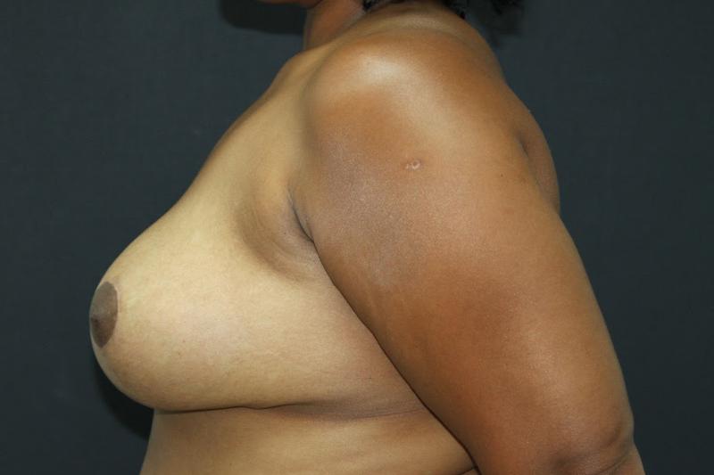 Breast Lift Case 6812, After Treatment, Female Patient, Set 3