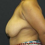 Breast Lift Case 6812, Before Treatment, Female Patient, Thumbnail 3