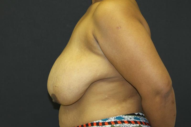 Breast Lift Case 6812, Before Treatment, Female Patient, Set 3