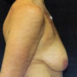 Breast Augmentation with Lift Case 6813, Before Treatment, Female Patient, Thumbnail 2