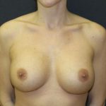 Breast Revision Case 6819, After Treatment, Female Patient, Thumbnail 1