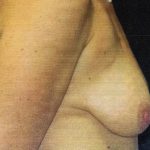 Breast Lift Case 6825, Before Treatment, Female Patient, Thumbnail 1