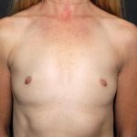 Breast Augmentation Case 6828, Before Treatment, Female Patient, Thumbnail 1