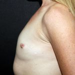 Breast Augmentation Case 6828, Before Treatment, Female Patient, Thumbnail 3