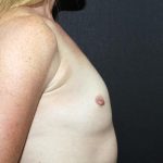 Breast Augmentation Case 6828, Before Treatment, Female Patient, Thumbnail 5