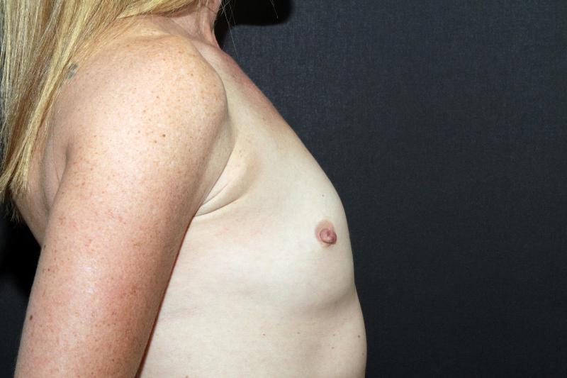 Breast Augmentation Case 6828, Before Treatment, Female Patient, Set 5