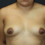 Breast Augmentation Case 6838, Before Treatment, Female Patient, Thumbnail 1