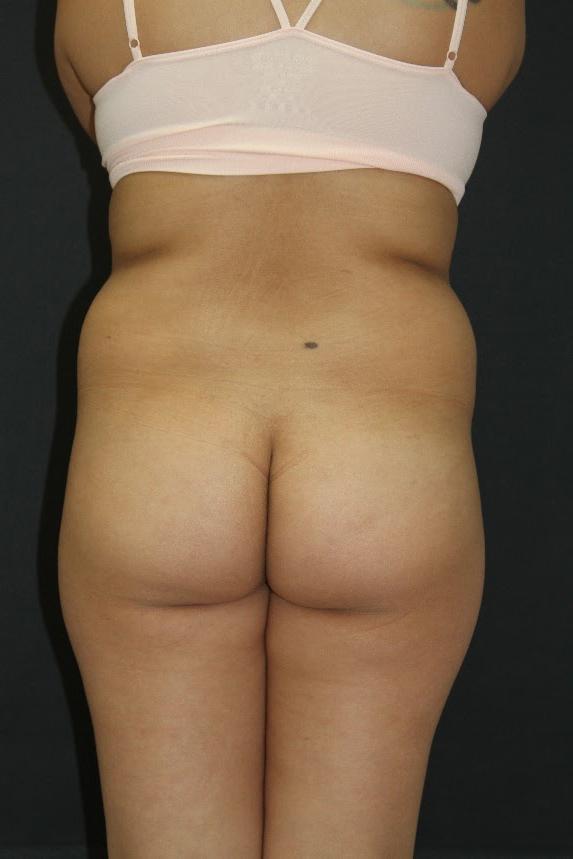 Jersey Shore Butt Lift Case 6839, Before Treatment, Female Patient, Set 5
