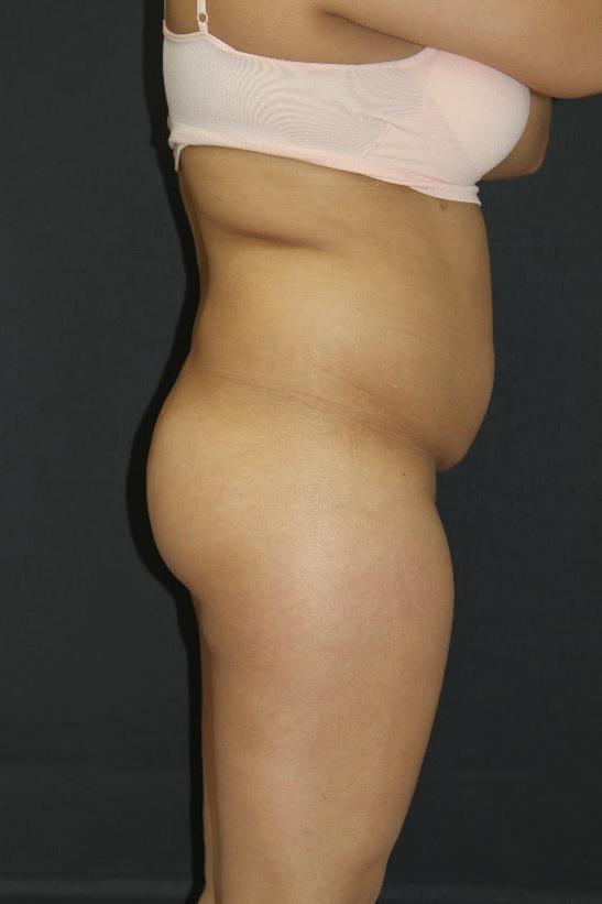 Jersey Shore Butt Lift Case 6839, Before Treatment, Female Patient, Set 2