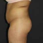 Jersey Shore Butt Lift Case 6839, Before Treatment, Female Patient, Thumbnail 4