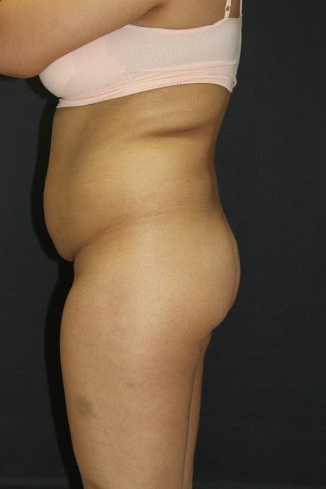 Jersey Shore Butt Lift Case 6839, Before Treatment, Female Patient, Set 4