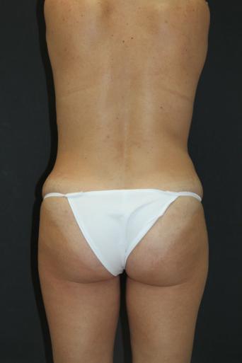Jersey Shore Butt Lift Case 6840, After Treatment, Female Patient, Set 3