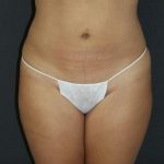 Liposuction Case 6845, After Treatment, Female Patient, Thumbnail 1