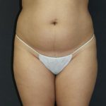 Liposuction Case 6845, Before Treatment, Female Patient, Thumbnail 1